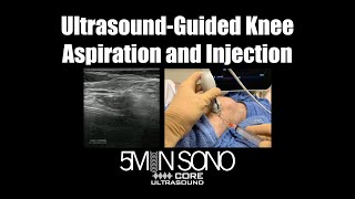 UltrasoundGuided Knee Aspiration and Injection A StepbyStep Guide [upl. by Max]