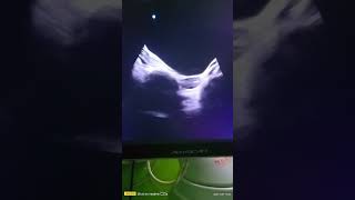 BOTH OVARY SCAN  ultrasound USG ovary [upl. by Tahp]