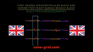 Electrocardiography  First Degree Atrioventricular Block And Intermittent Right Bundle Branch Block [upl. by Eimorej]