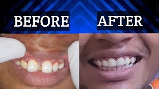 Closing the Gap Effective and Affordable Teeth Gap Treatment Options [upl. by Nytsua583]