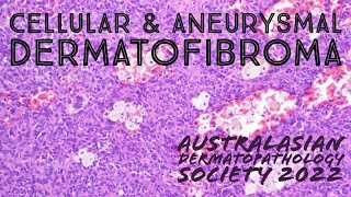 Cellular Dermatofibroma amp Aneurysmal Dermatofibroma 101 pathology dermpath dermatology [upl. by Clotilda]