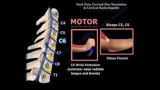 Neck Pain Cervical Disc Herniation amp Radiculopathy [upl. by Eerehs802]