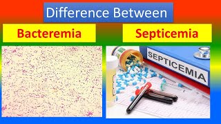 Difference between Bacteremia and Septicemia [upl. by Fayette]