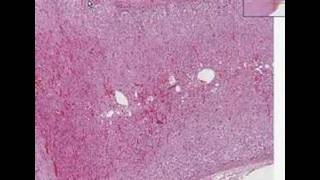 Histopathology AdrenalCortical adenoma [upl. by Eddina]