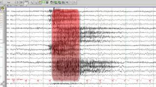 EEG in Juvenile Myoclonic Epilepsy [upl. by Eitsyrc]