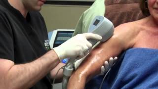 Exilis for Skin Tightening on a Womans Arms with Dr Seiler [upl. by Ttik]