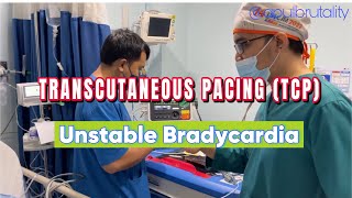 Emergency transcutaneous pacing TCP in unstable bradycardia [upl. by Ardnauqal]