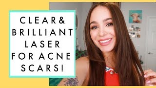 LASER TREATMENT FOR ACNE SCARS My 2 Week Progress [upl. by Anikas950]