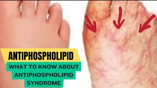 Antiphospholipid Syndrome [upl. by Concoff]