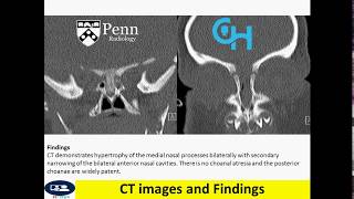 Congenital nasal pyriform aperture stenosis Newborn with respiratory distress [upl. by Einegue]