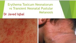 Erythema Toxicum Neonatorum VS Transient Neonatal Pustular Melanosis [upl. by Blatt868]