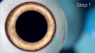 How does the ICL Implantable contact lens procedure work [upl. by Silra]