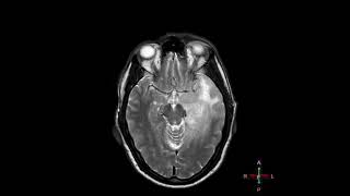 Gliomatosis cerebri [upl. by Kowalski]