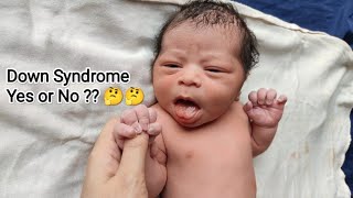 DOWN SYNDROME Girl is blessed with Newborn baby Boy just after birth  Is he a Down baby too  🤔 [upl. by Flossy]