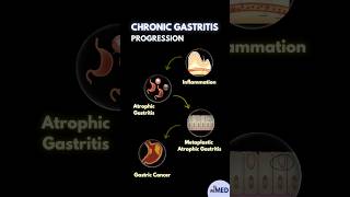 Progression of Chronic Gastritis minuteMED gastritis chronicgastritis [upl. by Veronique604]