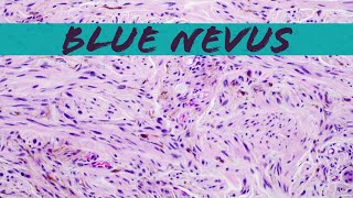 Blue Nevus pathology dermpath dermatology dermatopathology [upl. by Daniels]