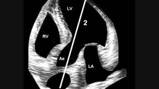 Aortic Regurgitation [upl. by Michaela]