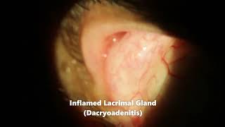 Dacryoadenitis Swollen Lacrimal Gland Coming Out of Eye [upl. by Sulakcin82]