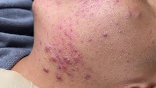 Blackheads amp Pimples Pore Removal New 2024FULL  Acne Treatment With Bo Nguyễn Spa [upl. by Guildroy906]