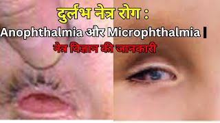 दुर्लभ नेत्र रोग Anophthalmia और Microphthalmia  नेत्र विज्ञान की जानकारी [upl. by Karlene]