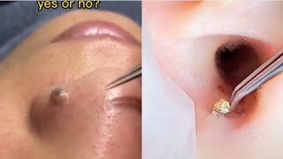 Ultimate Pimple Popping Compilation 2024 Satisfying Cyst amp Blackhead Removal [upl. by Neelhtak]