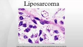 Liposarcoma [upl. by Luy]