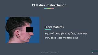 Cl II div 2 Malocclusion [upl. by Thaddeus595]