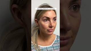 Trifecta Lift amp Duplex Combination Treatment with Dr Kami Parsa [upl. by Harv]