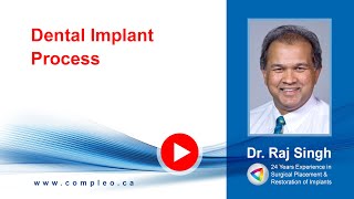 Dental Implant Process  Compleo Dental Clinic in Toronto Dr Raj Singh [upl. by Sophie]