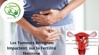 Les Tumeurs Bénignes et Infertilité Féminine [upl. by Niuqaoj]