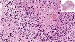 Glioblastoma  Histopathology [upl. by Stets606]