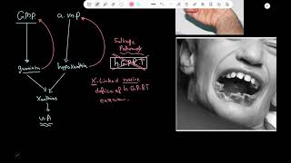 LeschNyhan syndrome  Pathology [upl. by Ennasus555]