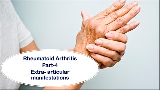 Rheumatoid arthritis Part4  Extraarticular manifestations [upl. by Accebber]