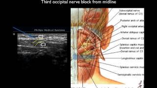 Ultrasound guided thrid occipital nerve block [upl. by Allimac710]