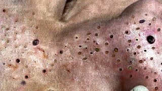 Big Cystic Acne Blackheads Extraction Blackheads amp Milia Whiteheads Removal Pimple Popping  3864 [upl. by Ty]