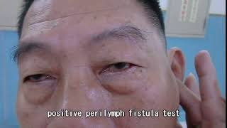 Positive perilymph fistula test [upl. by Esirehs]