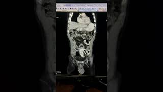 GASTROENTEROLOGY  Identify the spot diagnosis in given CECT ABDOMEN clip [upl. by Lohman]