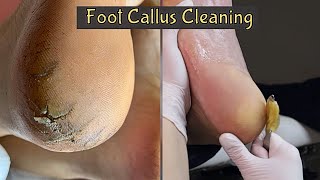 Callus Removal From Feet 👣 Foot Callus Removal Satisfying [upl. by Ennazor]