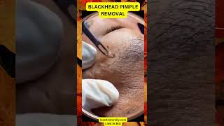 Get RID of BLACKHEADS in Just 5 Minutes [upl. by Brear681]