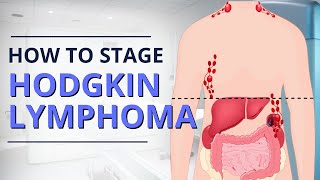 Hodgkin Lymphoma Staging From Diagnosis to Prognosis  The Patient Story [upl. by Claudian]