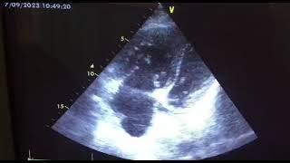 Right ventricular dualthrombi attaching to the chordae tendineae a case report [upl. by Ataymik]