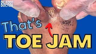 Thats Toe Jam The Buildup Between Toes Explained Trimming Of Fungal Toenails and Skin Scales [upl. by Kitrak]