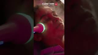 HydraFacial at Clear Skin Clinic Your Path to Glowing Skin  Clear Skin Pune [upl. by Anala182]