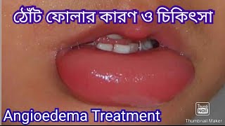 ঠোঁট ফোলার কারণ  ঠোঁট ফোলা কমানোর উপায়  Angioedema Treatment [upl. by Gilmore]