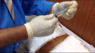 Biopsia de Medula Osea Indolora Painless Bone Marrow Biopsy [upl. by Nitfa201]