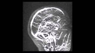 Angiographie  Dictionnaire français audio [upl. by Ilrebmik]