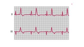 Arrhythmia 2 [upl. by Acirretal]