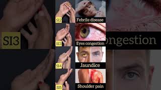 Febrile diseaseeyes congestion jaundice shoulder pain trending 2million biology shortsfeed [upl. by Cheke693]