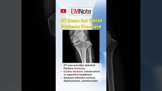 Tibial Plateau Fractures doctor medical trauma [upl. by O'Meara]