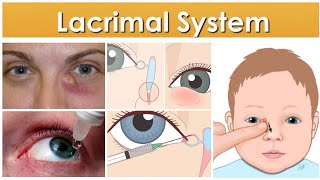 Lacrimal System 2 Major Topic Congenital and Acquired Nasolacrimal Duct Obstruction [upl. by Allac84]